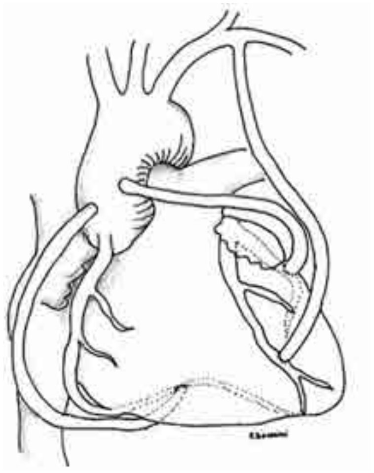 Figura 1. By pass coronario con arteria mamaria izquierda a la descendente anterior, radial desde aorta a la circunfleja y venoso 