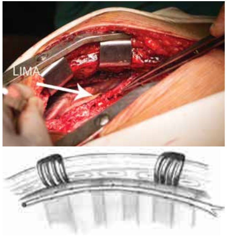 Figura 2. Esquema de la extracción de la arteria mamaria interna izquierda esqueletizada con la ayuda de un retractor colocado en 