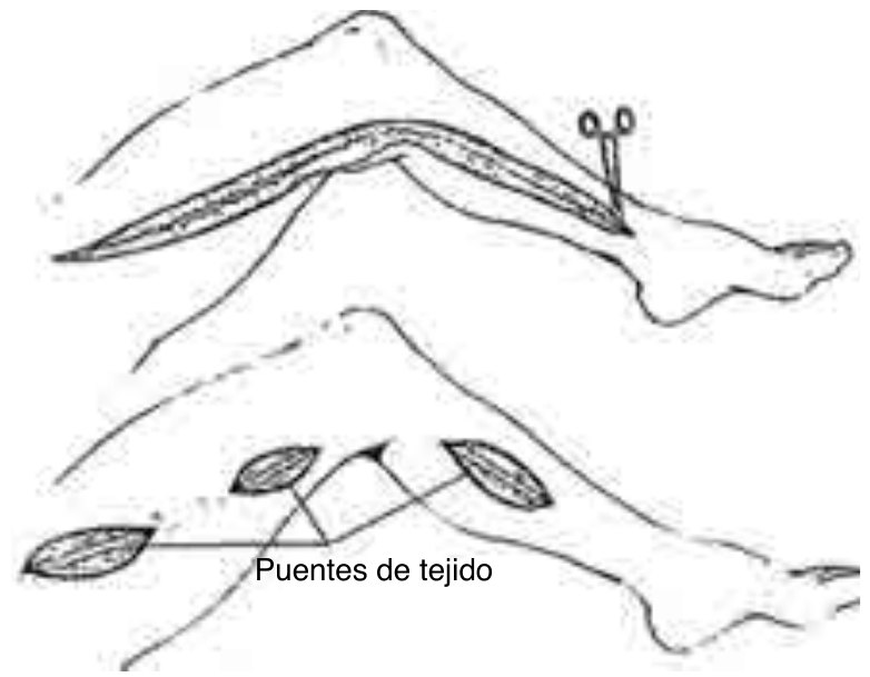 Figura 4. Extraccion de vena safena interna con incisión continua (arriba) y dejando puentes de tejido (abajo).
