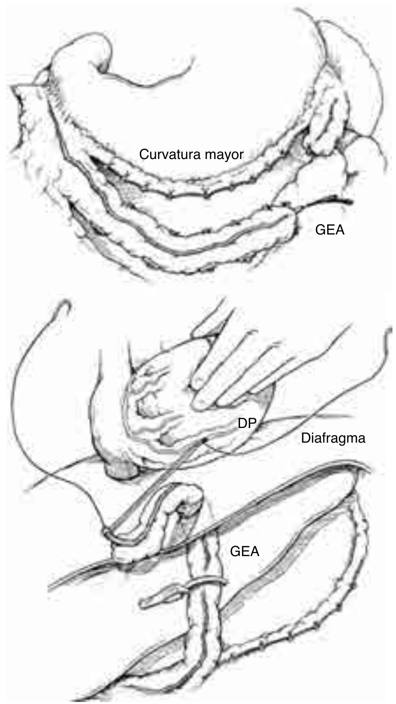 Figura 5. Esquema de la extracción de la arteria gastroepiploica a lo largo de la curvatura mayor del estómago. Luego de cortar la