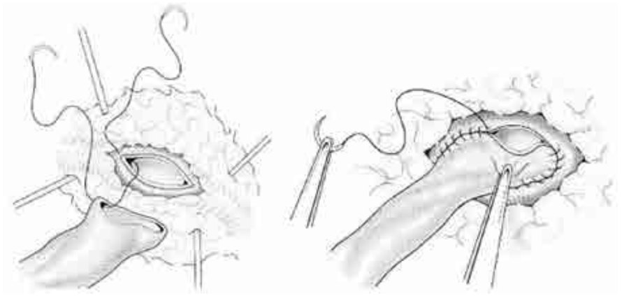Figura 7. Para la confección de las anastomosis se comienza desde el extremo proximal con surget de prolene 7/0 en sentido antihor