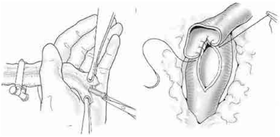 Figura 8. La boca distal de la arteria mamaria se prepara con cuidado de no desprender la íntima. Se puede opcionalmente colocar s