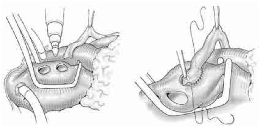 Figura 10. Confección de las anastomosis proximales. Clampeo parcial de la aorta, confección de orificios en la pared aórtica media