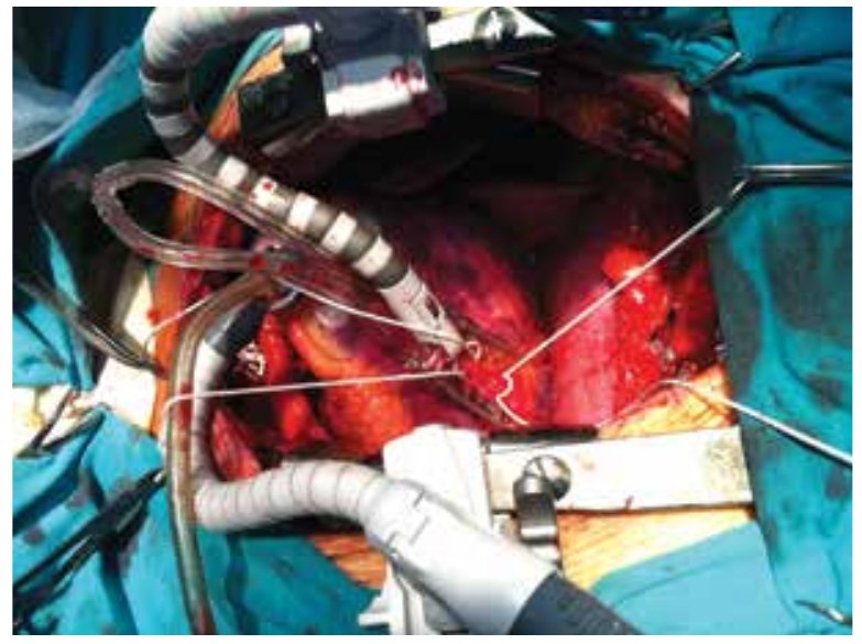 Figura 15. Posición para confeccionar by pass a la arteria coronaria derecha descendente posterior. El starfish se posiciona en el 