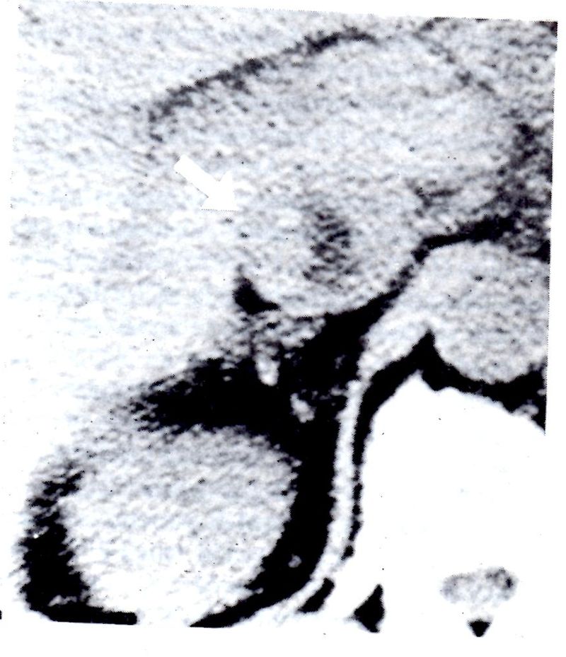 Figura 2 del artículo: corte de tomografía computada con una flecha que señala el trombo tumoral.