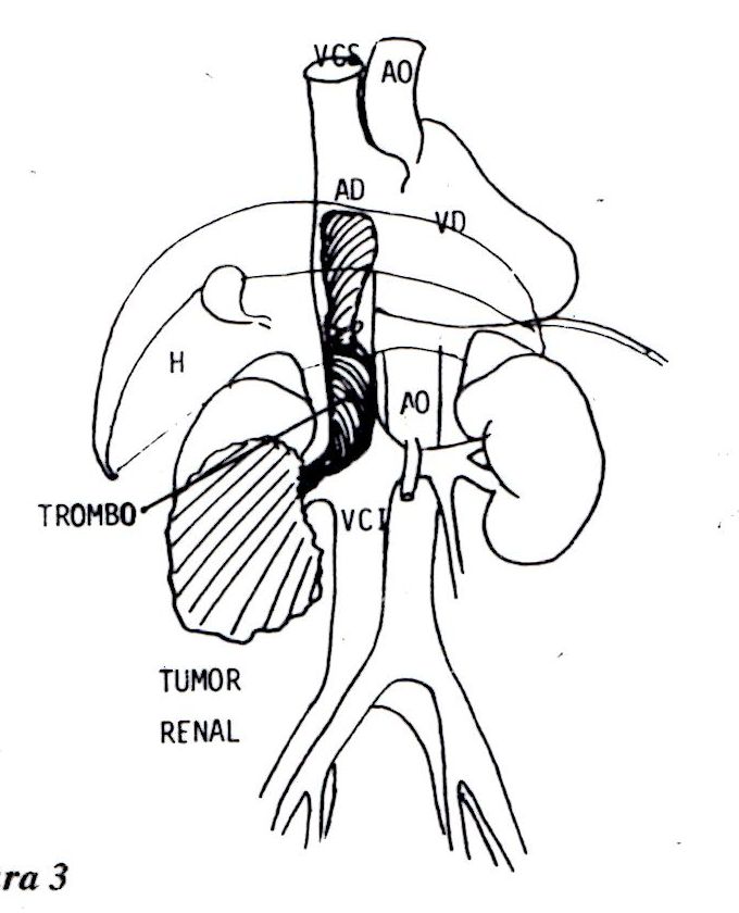 Figura 3 del artículo: esquema anatómico con el tumor renal, el trombo que asciende por la vena cava inferior hasta la aurícula derecha, la aorta, el hígado y el ventrículo derecho.