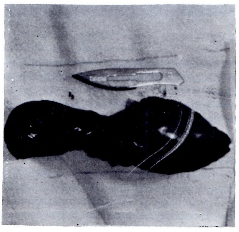 Figura 4 del artículo: fotografía del trombo tumoral extraído, junto a una hoja de bisturí como referencia de tamaño.